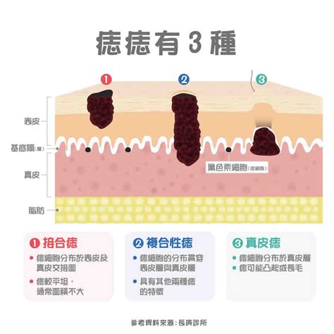 長痣原因|痣變大、痣多或長毛會變皮膚癌？認識痣的形成與原因